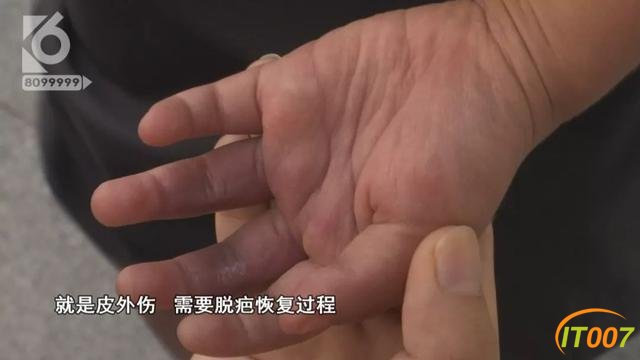 2岁女孩被跑步机夹伤，爸爸同意接受3千元赔偿，妈妈索赔18万-11.jpg