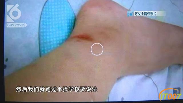 “老师不要打不要打”三岁幼儿晚上噩梦惊醒！家长多次发现手脚淤青-3.jpg